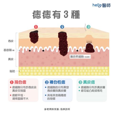 痣怎麼來的|痣是怎麼形成的？